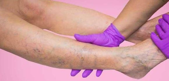 Mencegah Varises dengan Olahraga Tips dari Spesialis Kesehatan Mencegah Varises dengan Olahraga Tips dari Spesialis Kesehatan