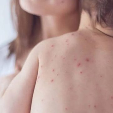 Masyarakat diminta waspadai penularan campak saat silaturahmi Lebaran