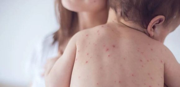 Masyarakat diminta waspadai penularan campak saat silaturahmi Lebaran