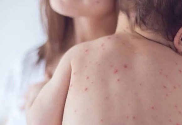 Masyarakat diminta waspadai penularan campak saat silaturahmi Lebaran